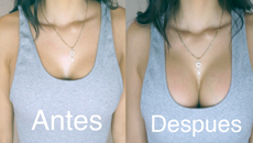 Upbra Lift up Bra before and after